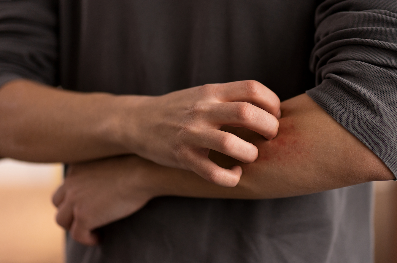 No-See-Um Bites Treatment